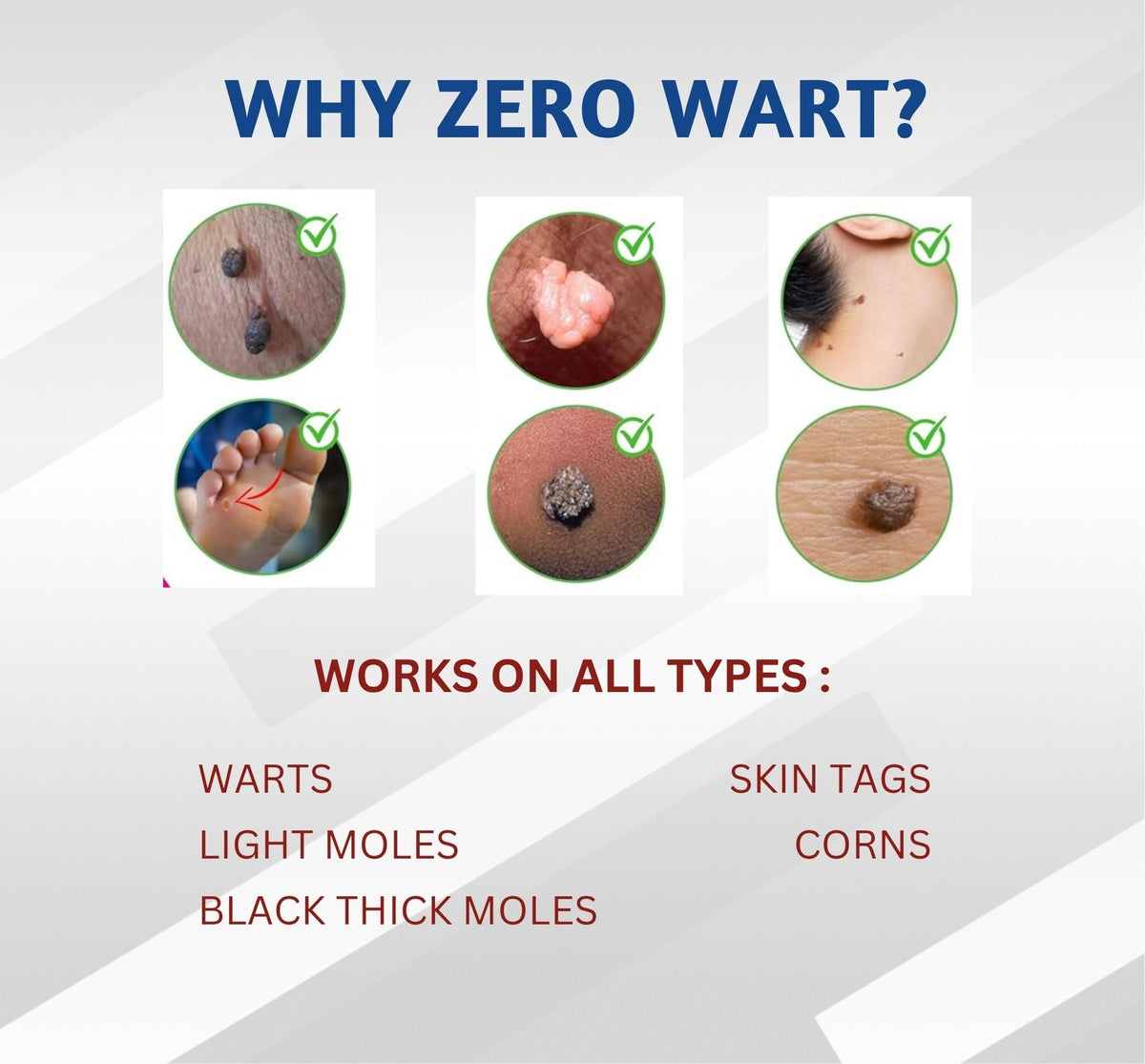 Zero Wart 5ml - Effective Wart Remover Solution (PACK OF 2)-5