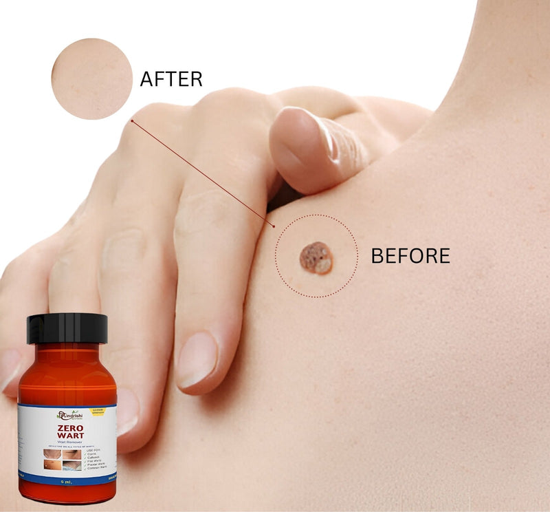 Zero Wart 5ml - Effective Wart Remover Solution (PACK OF 2)-7